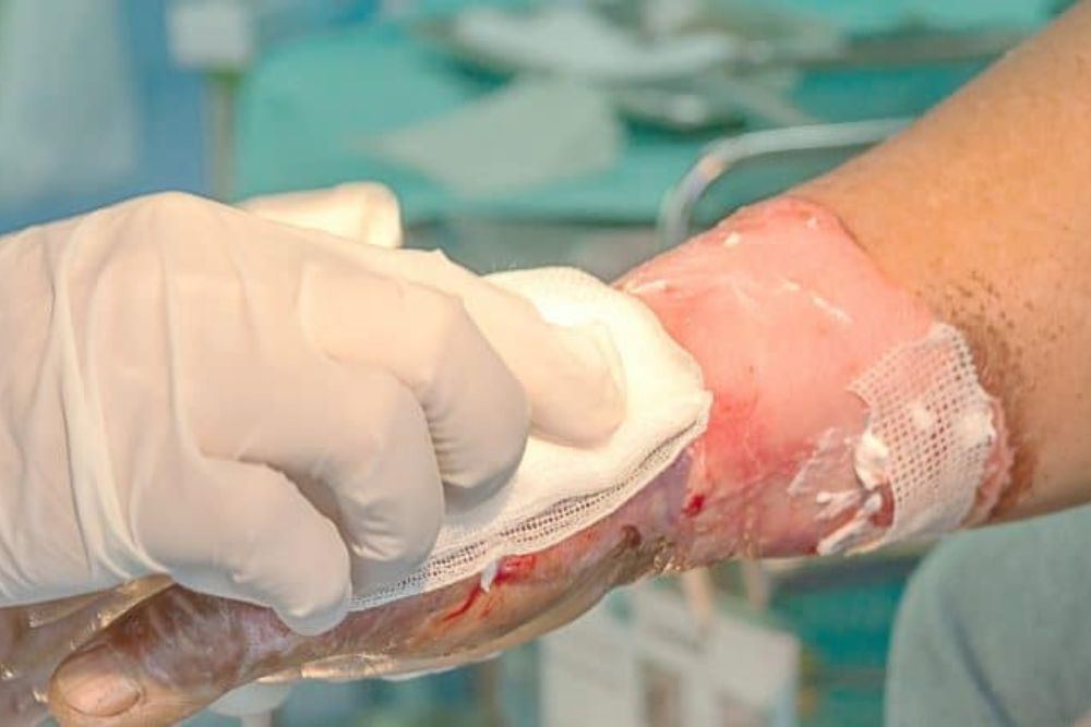 Burn ICU Services